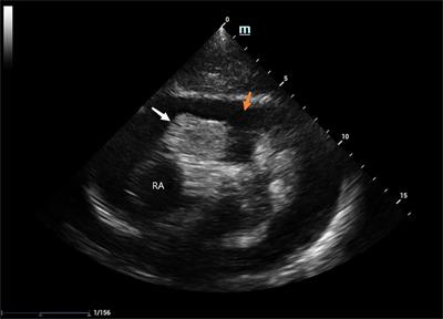 Case report of a ruptured right atrial aneurysm in a child and a comprehensive literature review